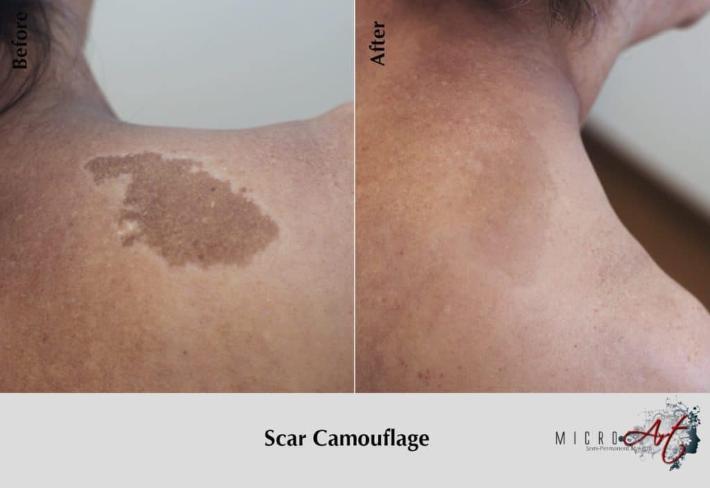 Permanent Makeup for Scars